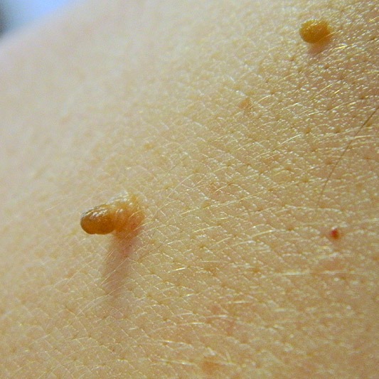tratamentul pielii cu papilom